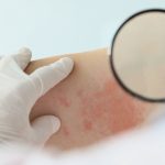 Опоясывающий герпес поражает нервные узлы и может оставить боль после сыпи