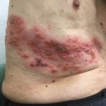 Боль после опоясывающего герпеса может нарушать сон даже после исчезновения сыпи