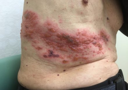 Боль после опоясывающего герпеса может нарушать сон даже после исчезновения сыпи